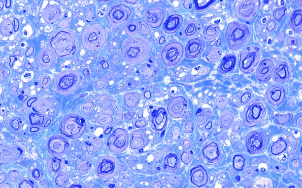 18G1 Vesicular Myelin Change Artifact Plastic 100X 3