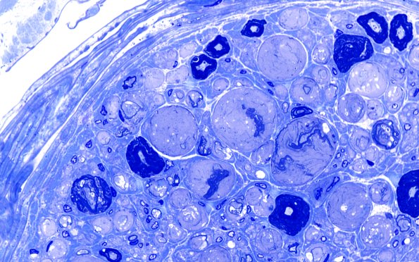 18G3 Artifact, vesicular myelin Plastic 100X 5