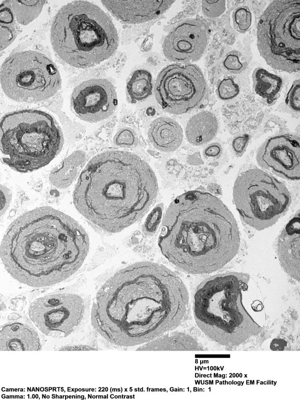 19A1 Vesicular myelin artifact EM 004 - Copy