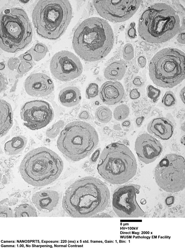 19A2 Vesicular myelin artifact EM 011 - Copy