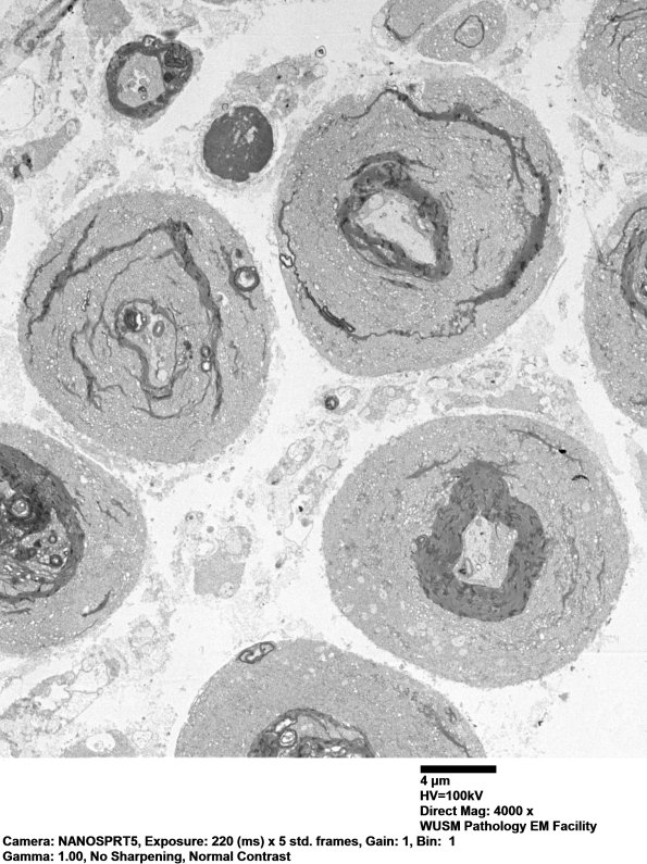 19A3 vesicular myelin artifact EM 002 - Copy