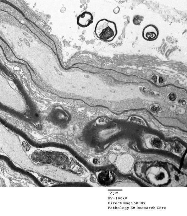 19C1  Artifact, vesicular myelin, spinal root EM 021A - Copy