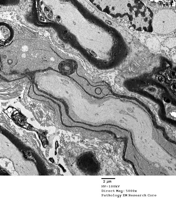 19C4 Artifact, vesicular myelin, spinal root EM 030A - Copy
