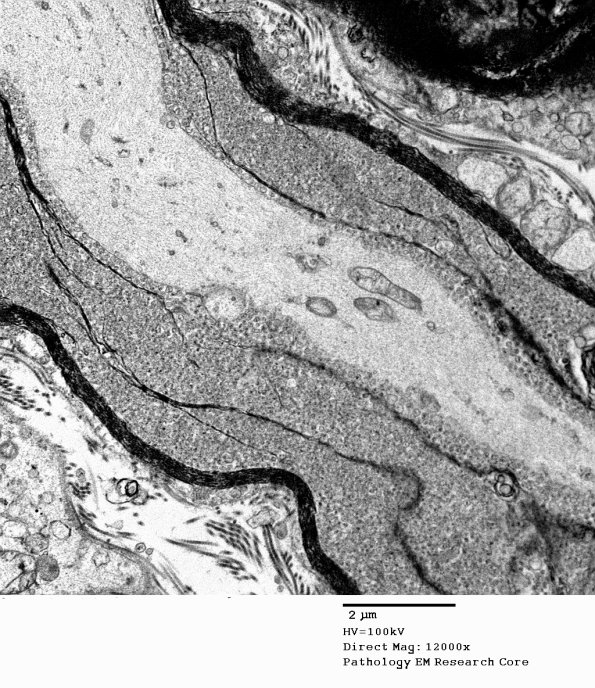 19C5 Artifact, vesicular myelin, spinal root EM 032A - Copy