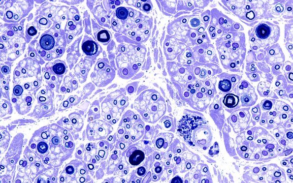 1B Neuropathy Vacuolated Plastic 100X 4