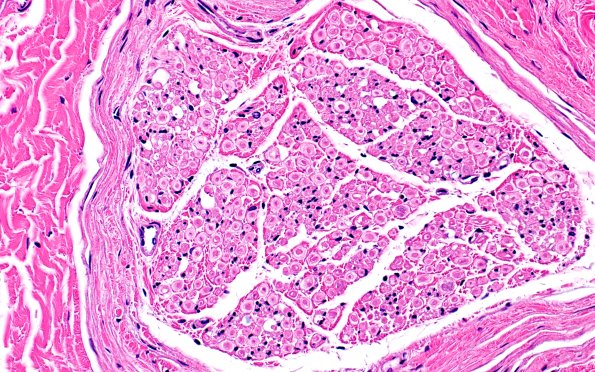 20A1 Artifact, delayed fixation (Case 20) 40X 1