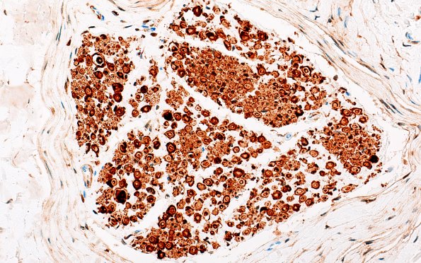 20B1 Artifact, delayed fixation (Case 20) S100 40X 1