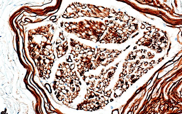 20C1 Artifact, delayed fixation (Case 20) Coll IV 40X 1