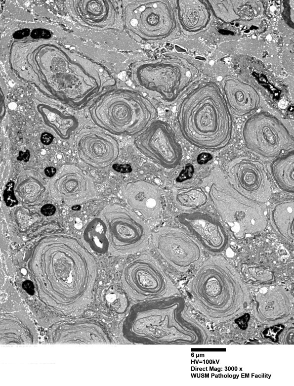 20E1 (Case 20) Sciatic_028 - Copy