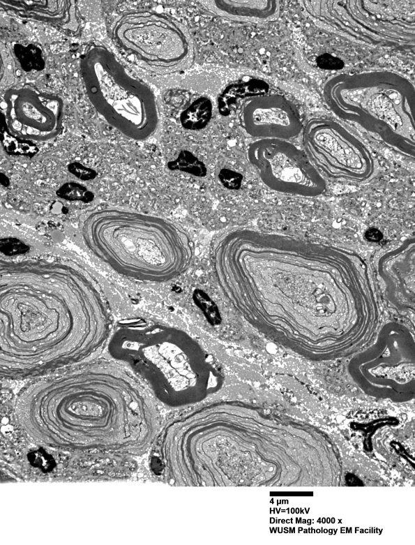 20E2 (Case 20) Sciatic_006 - Copy