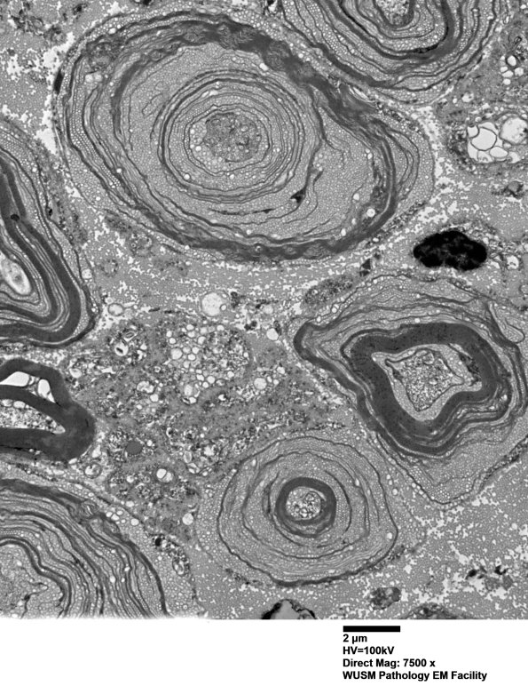 20E3 (Case 20)  Sciatic_015 - Copy