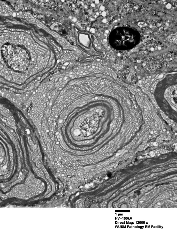 20E4 (Case 20)  Sciatic_023 - Copy