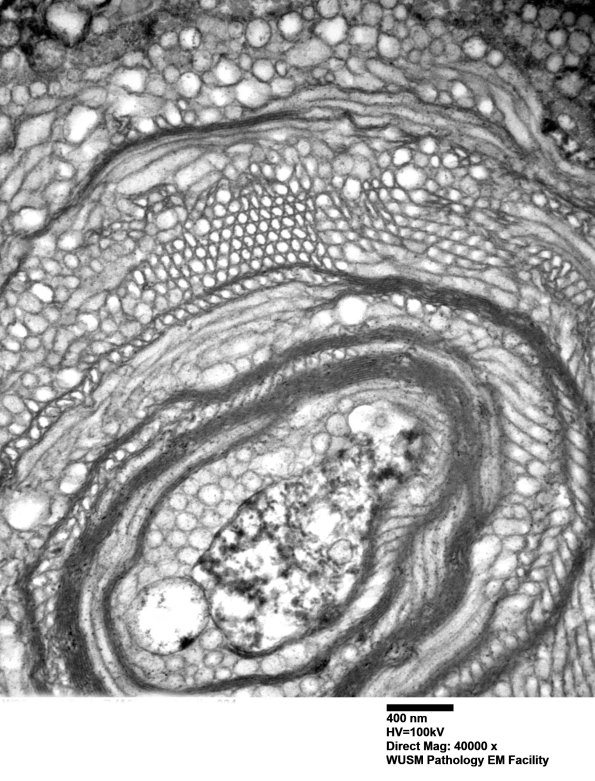 20E5 (Case 20) Sciatic_024 - Copy