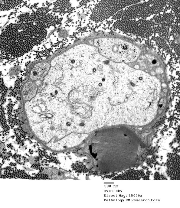 3A1 pseudo-demyelinated axons EM 027 - Copy