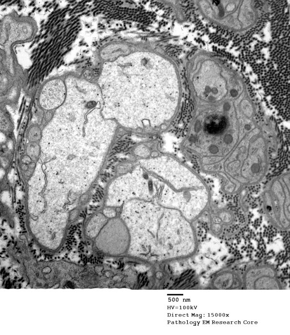 3C Ax Degen artifact-pseudo-demyelinated axons EM 026 - Copy