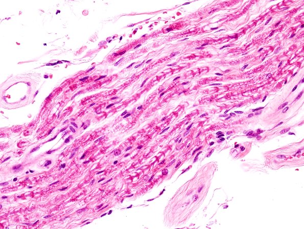 5A Cerebroretinal Vasculopathy (CRV, TREX, HERNS) H&E 4