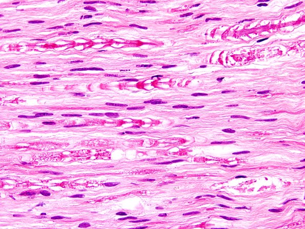5B Artifact, arrowheads, & crush, sural nerve H&E 3.jpg