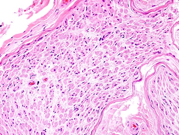 5D Artifact, neurokeratin H&E 2