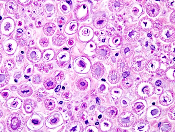 5F Neurokeratin artifact Cheetah ventral root H&E 1