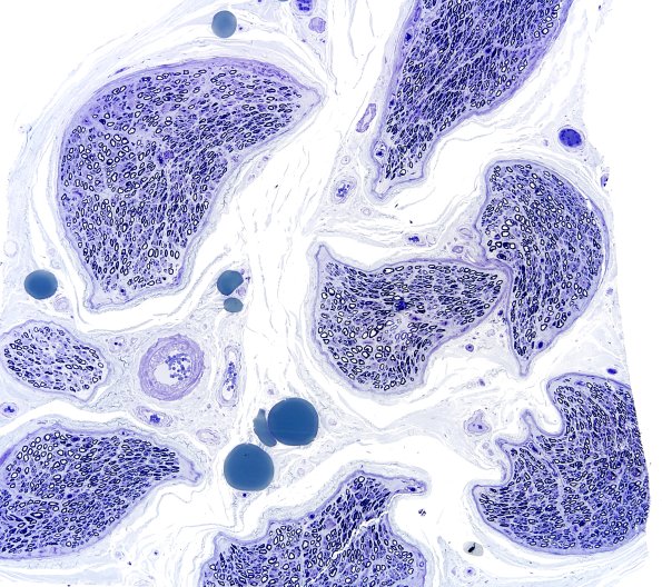 6A1 Artifact, hyperosmolar Plastic 1A