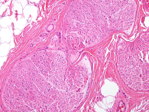 6B1 Artifact, perineurial shape H&E 1