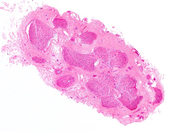 6C1 Crush artifact 4X