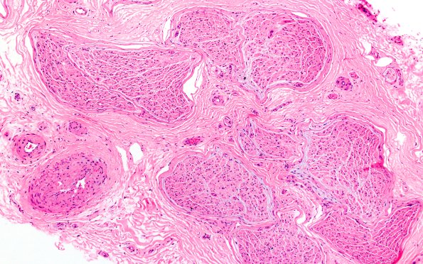 6C2 Crush artifact 10X 1