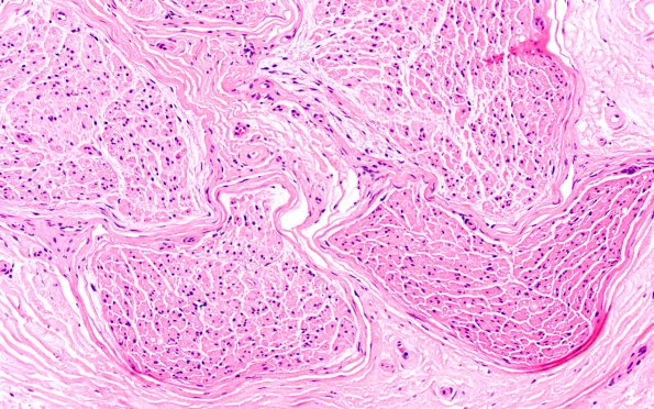 6C3 Crush artifact 20X 1