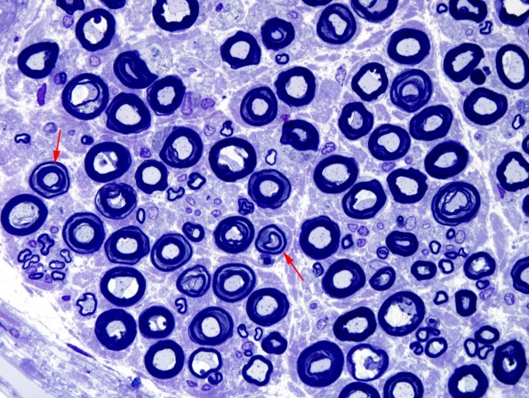 7A1 Artifact, pseudo-Schmidt-Lanterman Plastic 5 copy.jpg