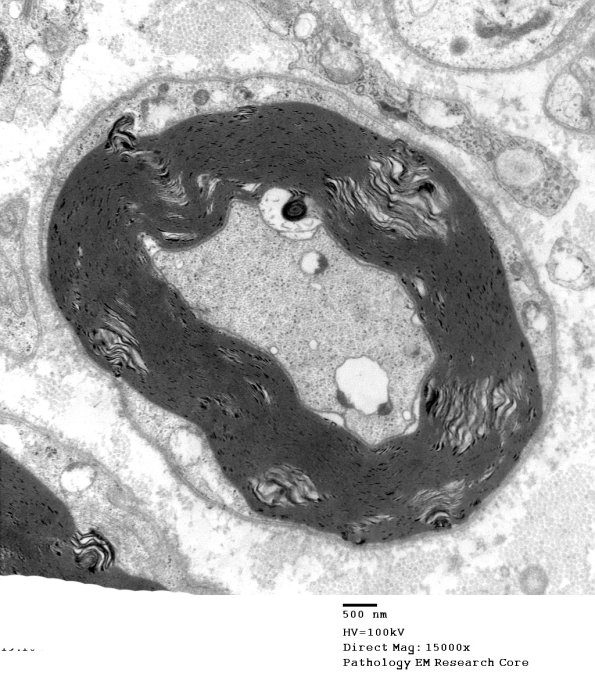 7B1 Artifact, separation myelin, Amiodarone (B1899)_005a - Copy