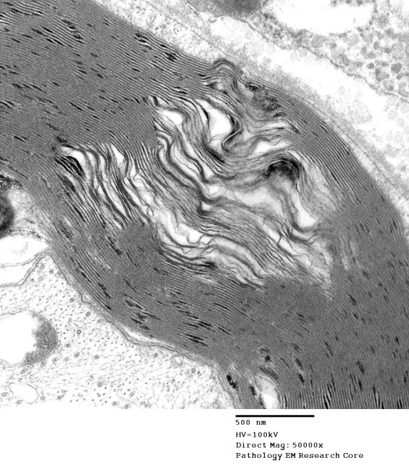7B2 Artifact, separation myelin, Amiodarone _006a - Copy