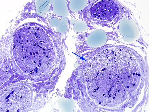 9A1 Artifact, electrocautery Plastic 4 copy.jpg