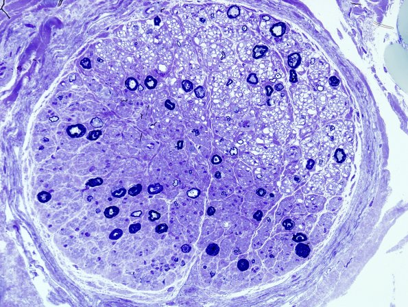 9A2 Artifact, electrocautery Plastic 1.jpg