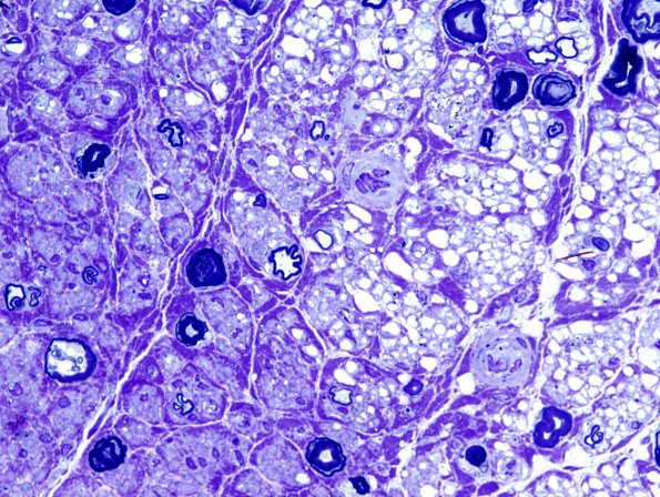 9A3 Artifact, electrocautery Plastic 3.jpg