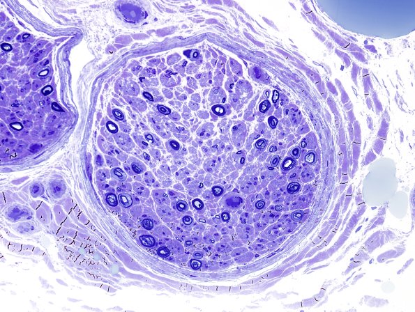 9A4 artifact, electrocautery deeper cuts same fascicle Plastic 1.jpg