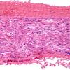 10A Peripheral nerve, wavy appearance, three dimensional appearance (Case 10) H&E