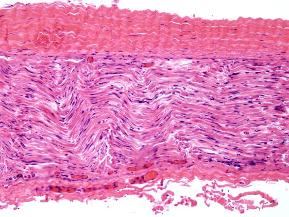 10A Peripheral nerve, wavy appearance, three dimensional appearance (Case 10) H&E