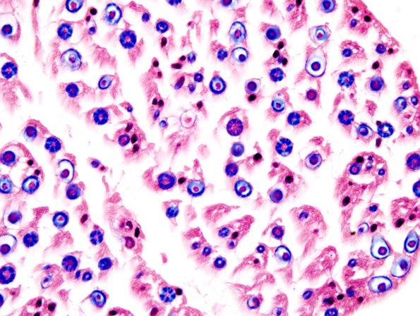 11A Normal (near normal) Nerve (Case 11) LFB-H&E 5
