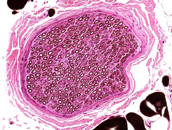 12A Nerve, Posterior Cutaneous (Case 12) Osmium & H&E.jpg