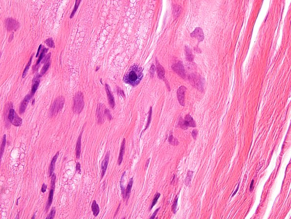 15A Mast Cell (Case 15) H&E 2