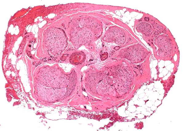 1A1 Nl sural H&E (Case 1)