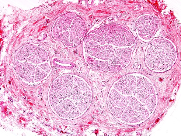 2A Normal Sural Nerve (Case 2)1