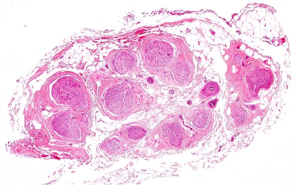 3A1 Normal Nerve (Case 3) H&E 1