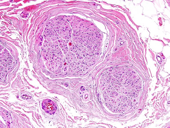 3A2 Normal Nerve (Case 3) H&E 2