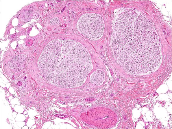 4A Nl sural H&E (Case 4) 2