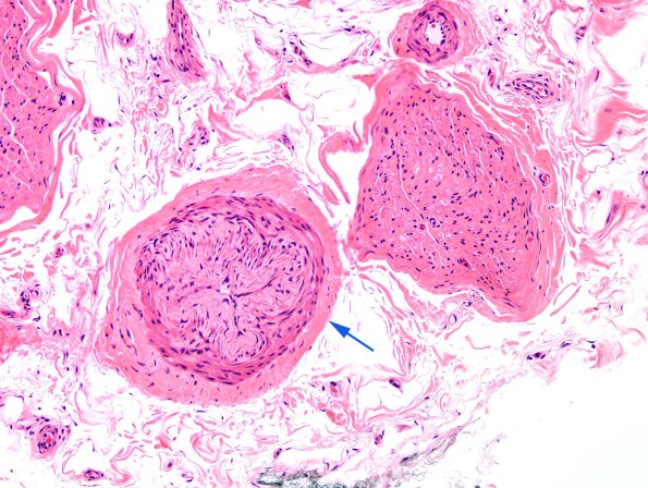 7A Normal Sural nerve, normal, contracted vessel (Case 7) H&E copy