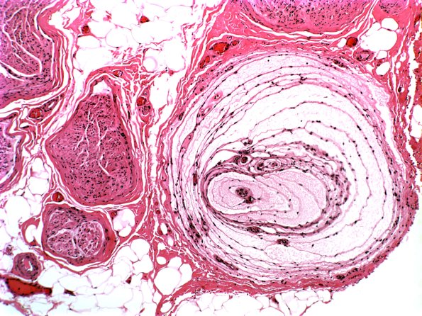 9A Normal sural nerve (Case 9) Pacinian corpuscle H&E 2