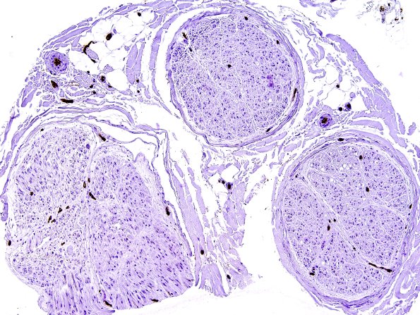 10A Normal Nerve (Case 9) Ulex 1