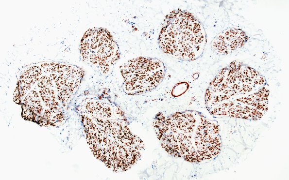 3A1 Nerve fibers (Case 3) CD56 IHC NCAM 10X A