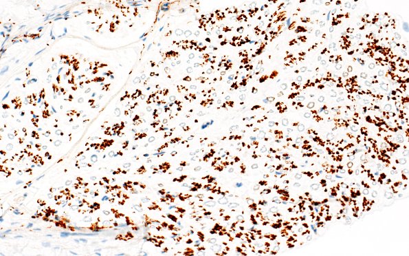 3A2 Nerve fibers (Case 3) CD56 IHC NCAM 40X 2